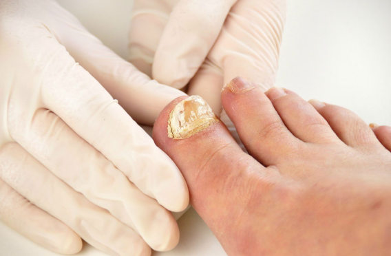 Fungal Toenail Care